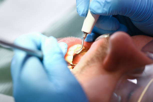 Best Emergency Root Canal Treatment in Murrysville, PA